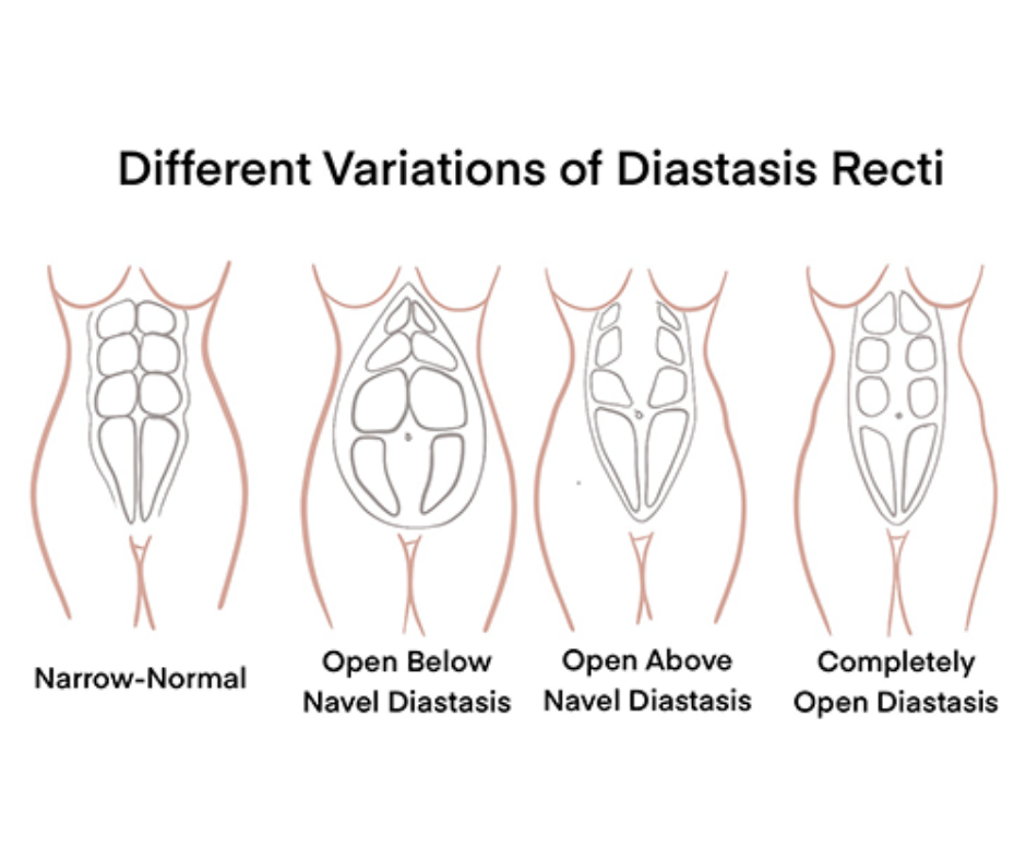 pelvic floor exercises prolapse